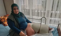 35 yıldır fil hastalığıyla mücadele ediyor